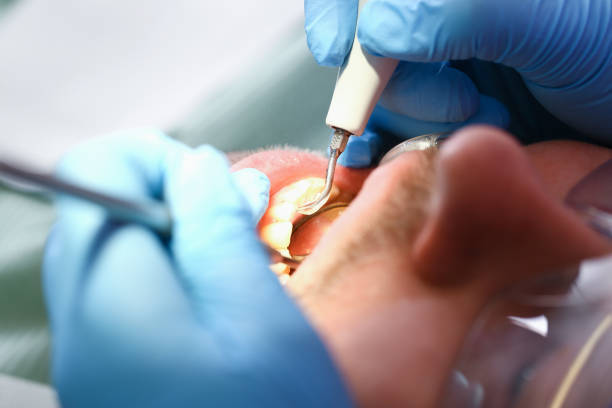 Best Emergency Treatment for Dental Infections or Abscesses in Forest Glen, MD